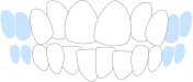 Crowded Teeth