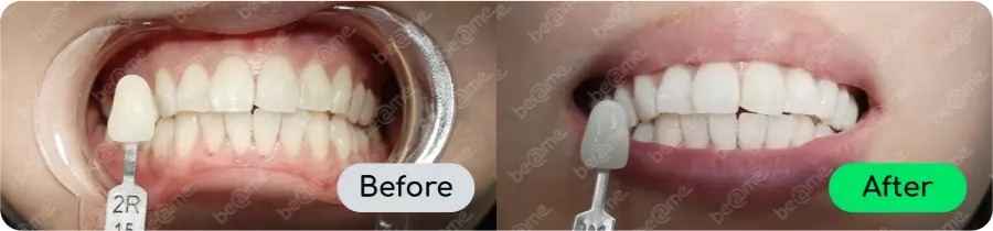 Before and after professional teeth whitening comparison