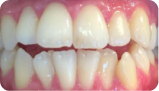 牙齒擁擠 Before