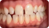 牙縫過大 Before