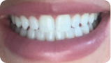 牙縫過大 After