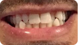 暴牙改善 Before