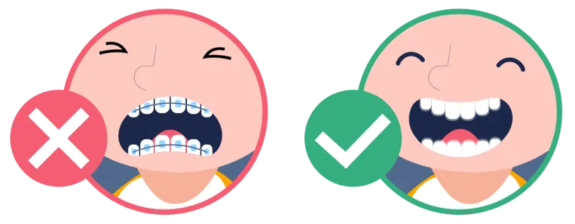 傳統金屬鋼箍容易造成小朋友箍牙感覺不適，同時也會影響外表，透明牙箍可以讓小朋友活動式佩戴牙箍。