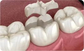 E.MAX瓷嵌體