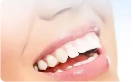 3M LAVA瓷嵌體