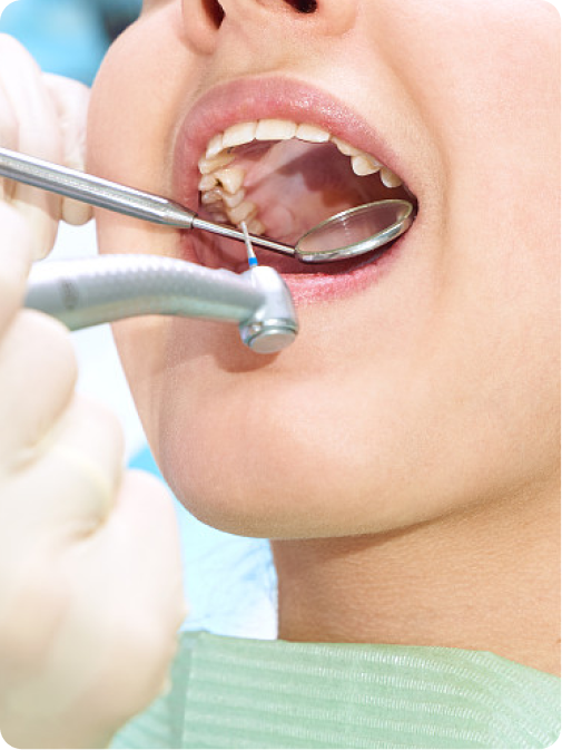 什麼是蛀牙 (Dental Caries)