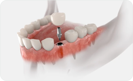 種植牙結構：牙冠 Crown · 基台 Abutment · 植體 Implant