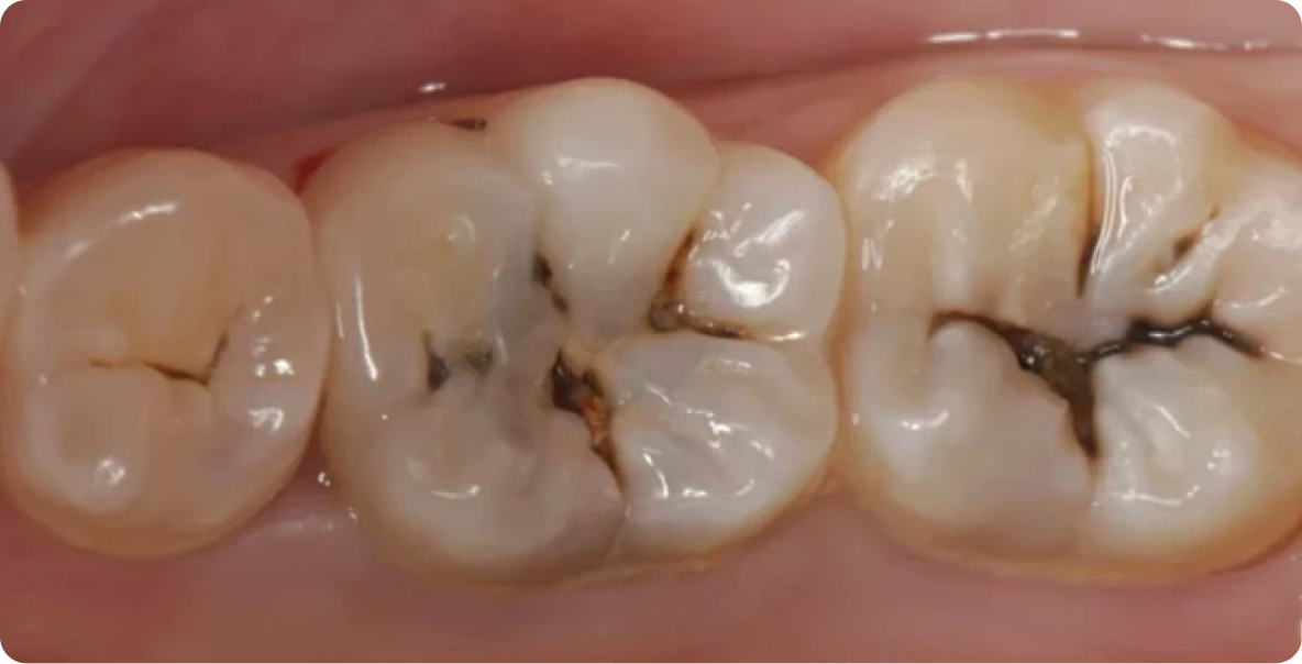 蛀牙（齲齒）臨床示意圖