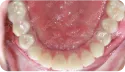 患者牙齒缺失 治療後