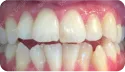 患者牙齒不齊、突 治療前