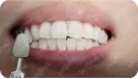 患者口腔狀況正常 治療後