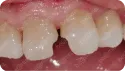 患者牙列缺損 治療前