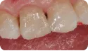 患者牙列缺損 治療後