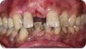 患者牙列缺損 治療前