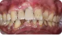 患者牙列缺損 治療後